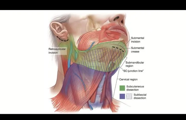 The deep plane neck, submandibular, and facial intervention achieves more natural results. Surgery time extends up to 6 hours