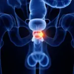 A new drug combination improves the treatment of aggressive prostate cancer