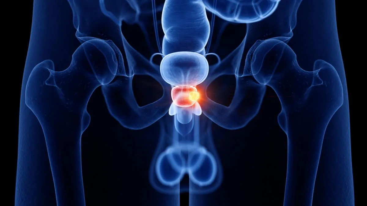 A new drug combination improves the treatment of aggressive prostate cancer