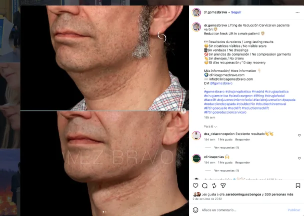 On @dr.gomezbravo's Instagram, it is possible to see real cases like this one, where the patient's Adam's apple becomes visible after the intervention