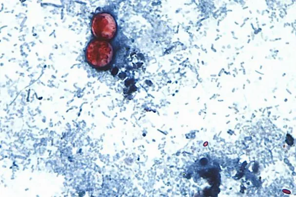 Photograph taken through a microscope showing Cyclospora cayetanensis oocysts found in a fresh stool sample 
