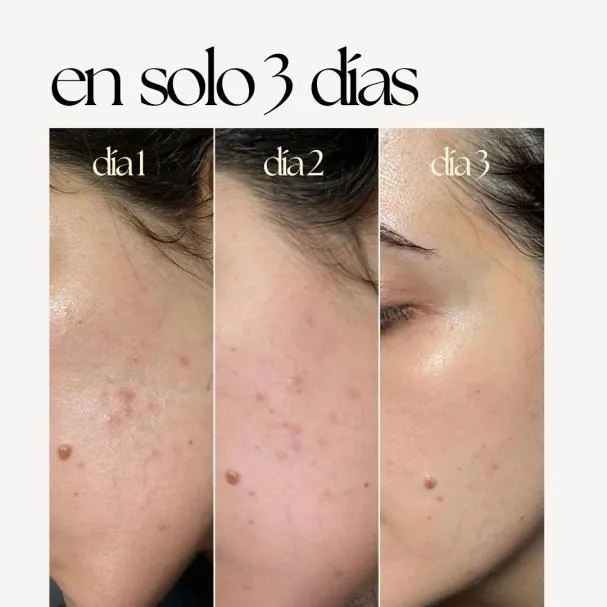 Effects of the Skin Correct treatment in just 3 days