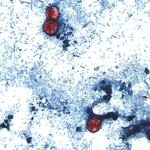 This photograph taken through a microscope shows Cyclospora cayetanensis oocysts found in a fresh stool sample