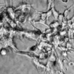 Moderna and Merck announce positive results in their melanoma vaccine trial